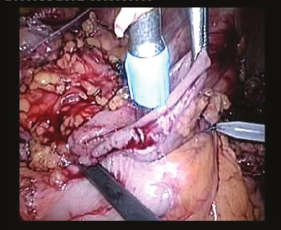 Intraperitoneální založení hlavice cirkulárního stapleru
Fig. 2: Intraperitoneal placement of the anvil