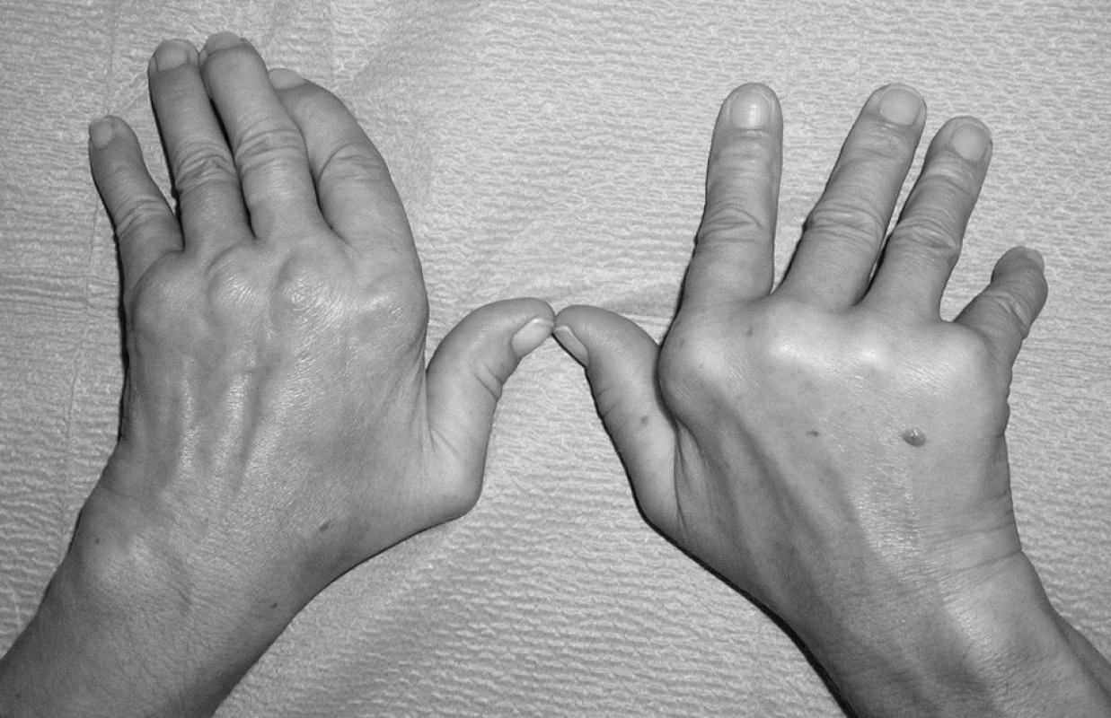 Jaccoudova artropatie u systémového lupus erytematodes (pozorování č. 5 v tab. 3 a 4).