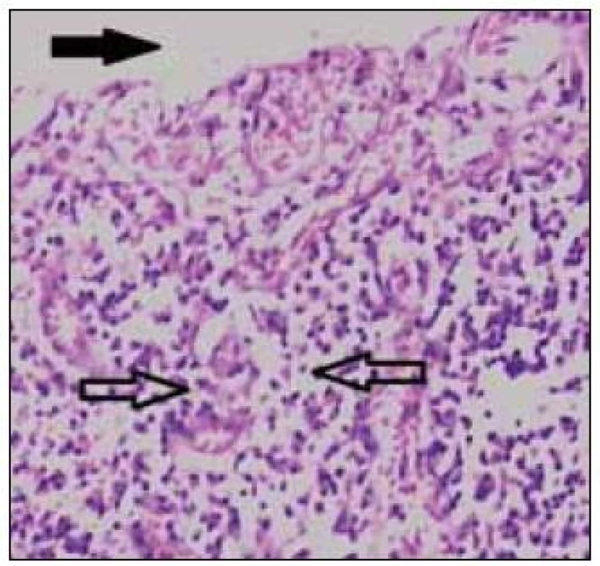 Histologické vyšetrenie. Luminálna časť čreva (plná šípka) a granulačné tkanivo zo spodiny defektu s výraznou vaskularizáciou a masívnou chronickou zápalovou celulizáciou (prázdne šípky). Známky malignity neprítomné. Hematoxylín a eozín, zväčšenie 100-krát.