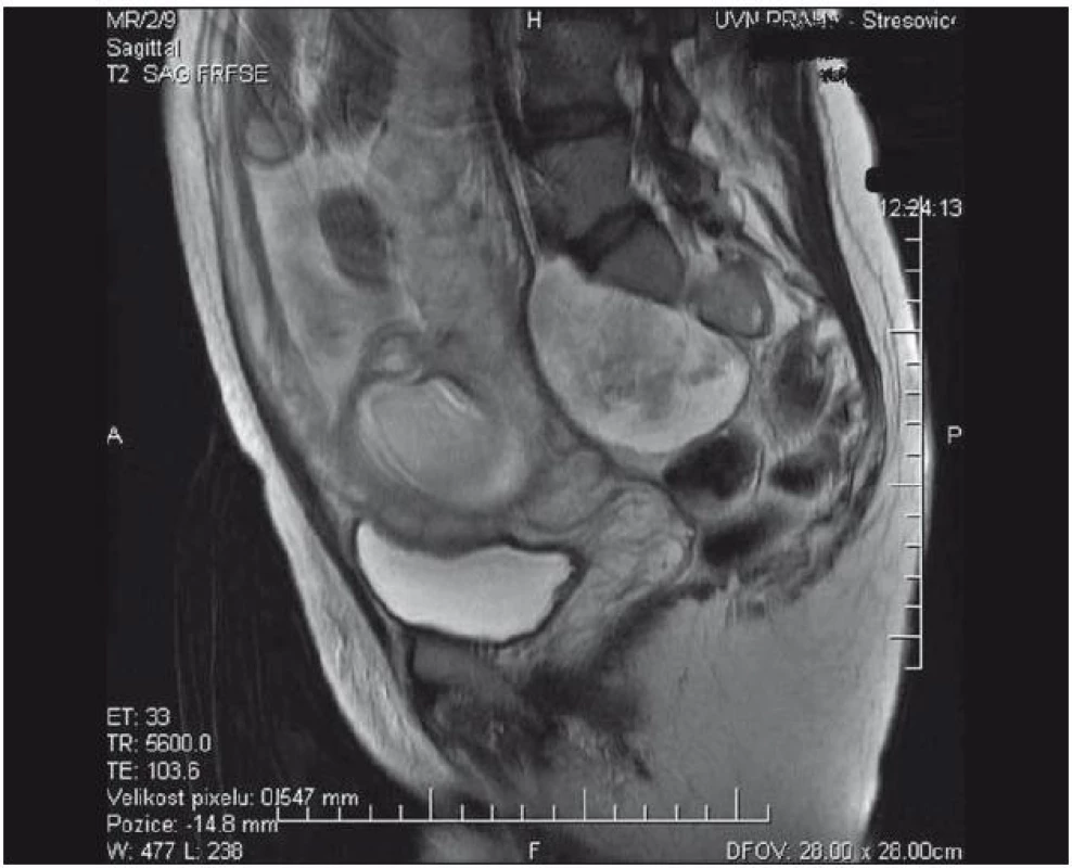 Presakrálně vyrůstající neurofibrom v T2 váženém MR zobrazení.