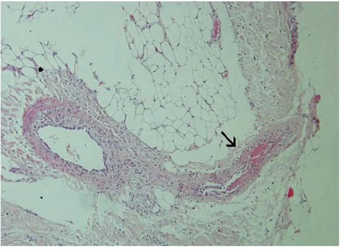 Histologický nález
Šipkou označená tepénka v septu subutis je trombotizována, její stěna je oslabená částečnou nekrózou (zvětšení 100krát, barvení HE).