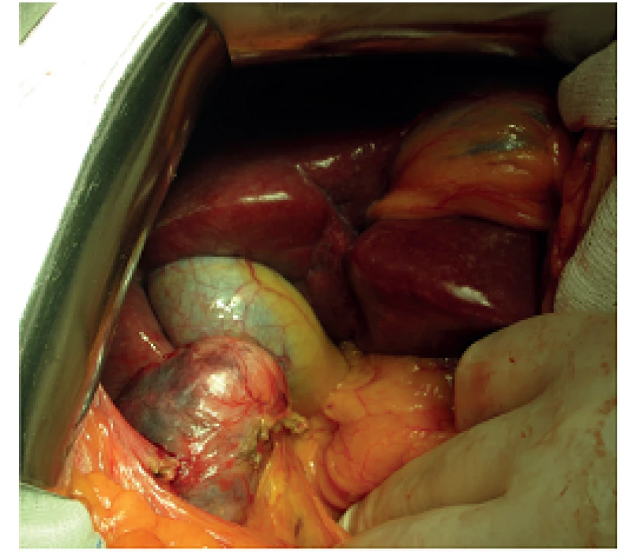 Peroperační nález
Fig. 3: Intraoperative findings