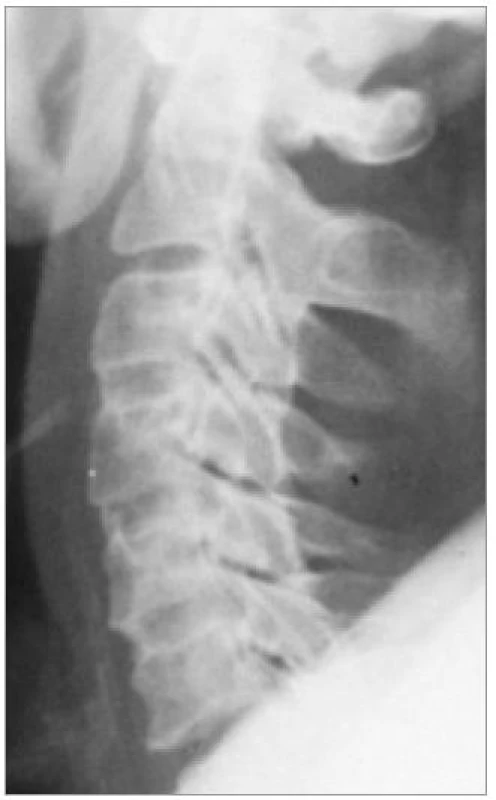 Stav po ACDF s autologními štěpy ve 3 etážích C3/4/5/6. Patrna velmi kvalitní osteointegrace štěpů v dobrém postavení páteře.
