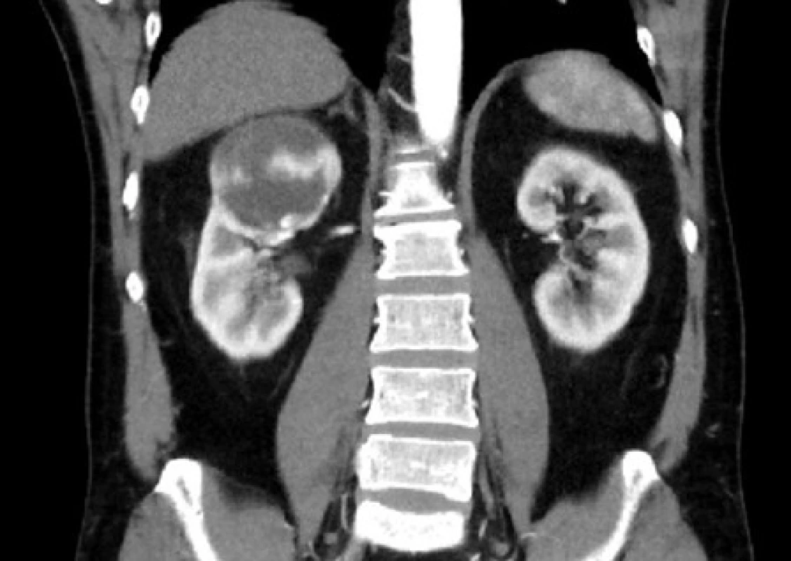 <i>MR zobrazení – Bosniak IV</i>
Fig. 7. <i>CT imaging – Bosniak IV</i>