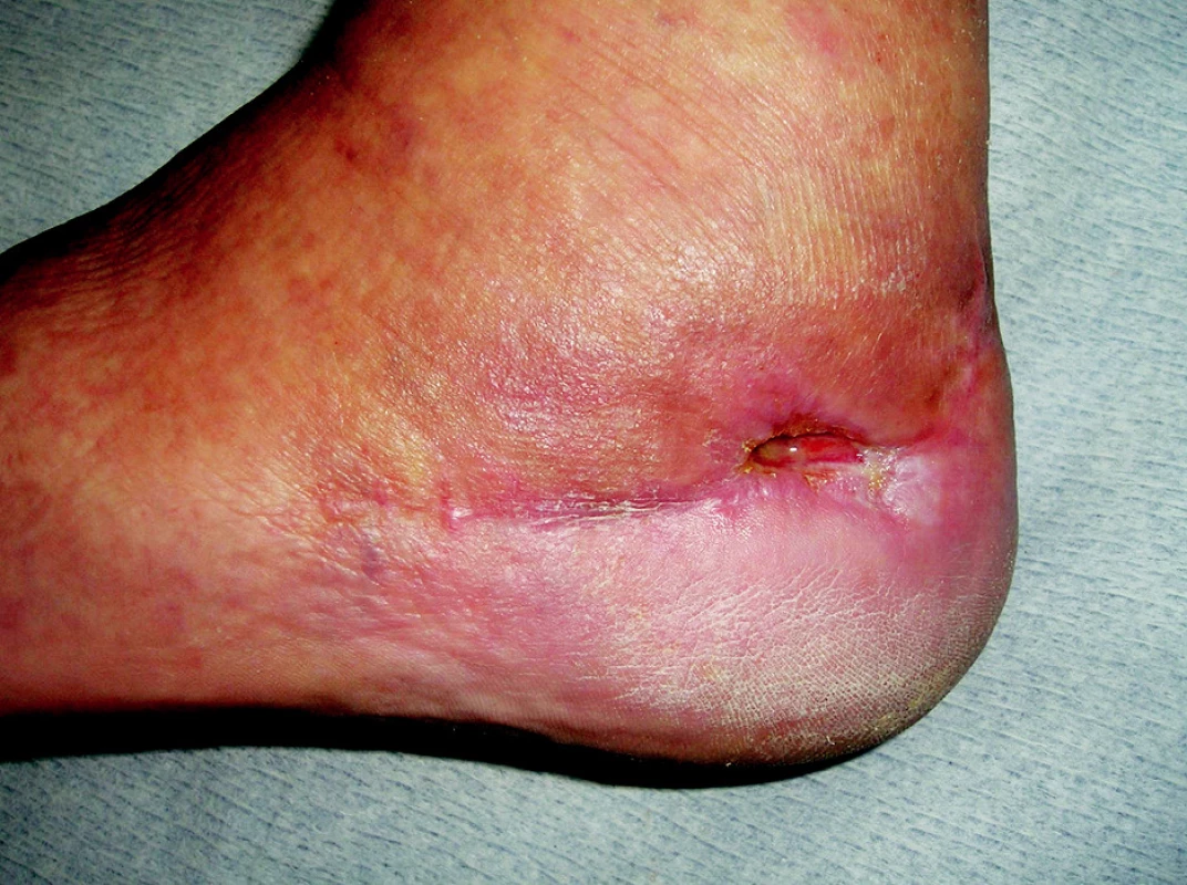 Hojící se ischemický defekt po apikální nekróze při špatně vedeném řezu
Fig. 4. Ahealing ischemic defect following apical necrosis in incorrectly performed incision