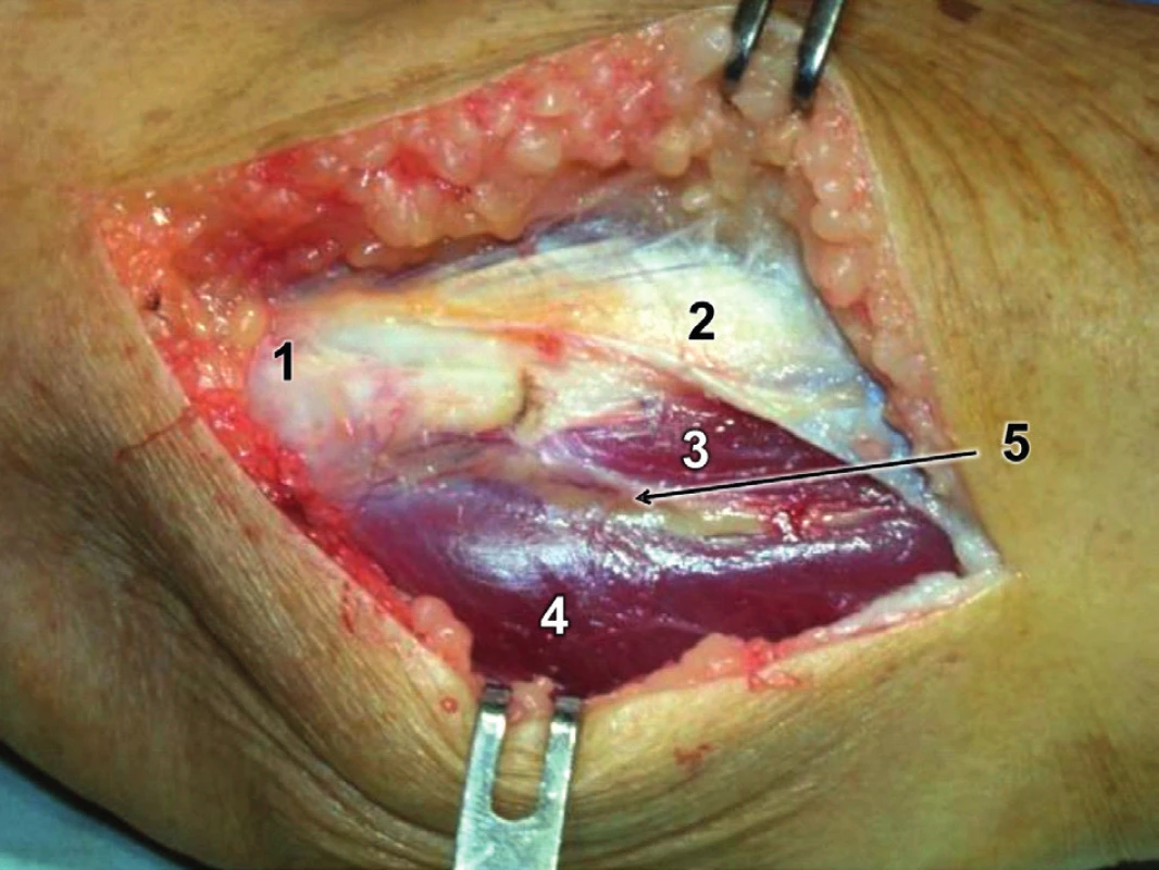 Modifikovaný Kocherův přístup – incize fascie: 1 – epicondylus lateralis humeri, 2 – odtažená fascie extenzorů, 3 – m. extensor carpi ulnaris, 4 – m. anconeus, 5 – Kocherův interval vyplněný tukovou tkání, ve které prosvítají větve a. interossea recurrens.
Fig. 8: Modified Kocher approach – fascia incision: 1 – lateral epicondyle of humerus, 2 – retracted extensor fascia, 3 – extensor carpi ulnaris, 4 – anconeus, 5 – Kocher interval filled with fatty tissue with visible branches of the interosseous recurrent artery.