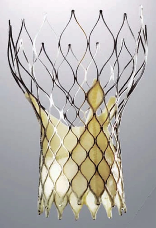 CoreValve Revalving System má samoroztažitelnou trojcípou chlopeň z vepřového perikardu.