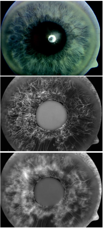a: Natívna snímka dúhovky pacienta pred podaním bevacizumabu. IOT 36 mm Hg
b,c: Fluoroangiografia dúhovky toho istého pacienta pred podaním bevacizumabu