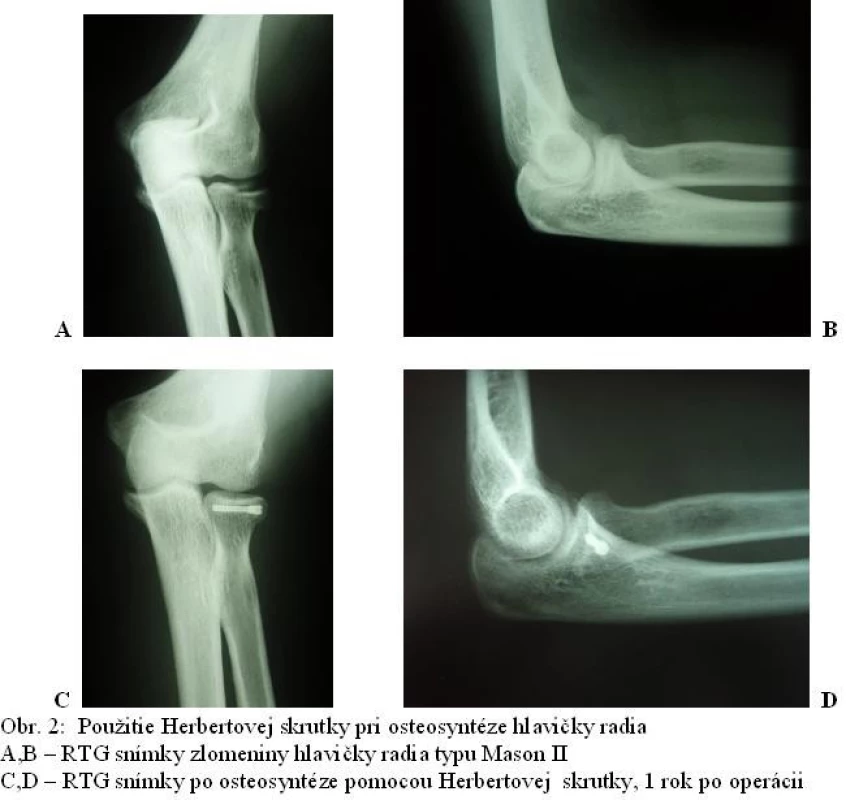 Použitie Herbertovej skrútky pri osteosyntéze hlavičky radia. A,B – RTG snímky zlomeniny hlavičky radia typu Mason II. C,D – RTG snímky po osteosyntéze pomocou Herbertovej skrútky, 1 rok po operácii