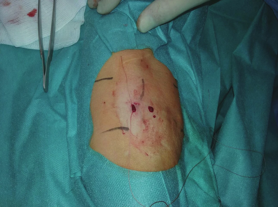 Zatažený steh se zanořením
Fig. 4: The suture is tightened and buried