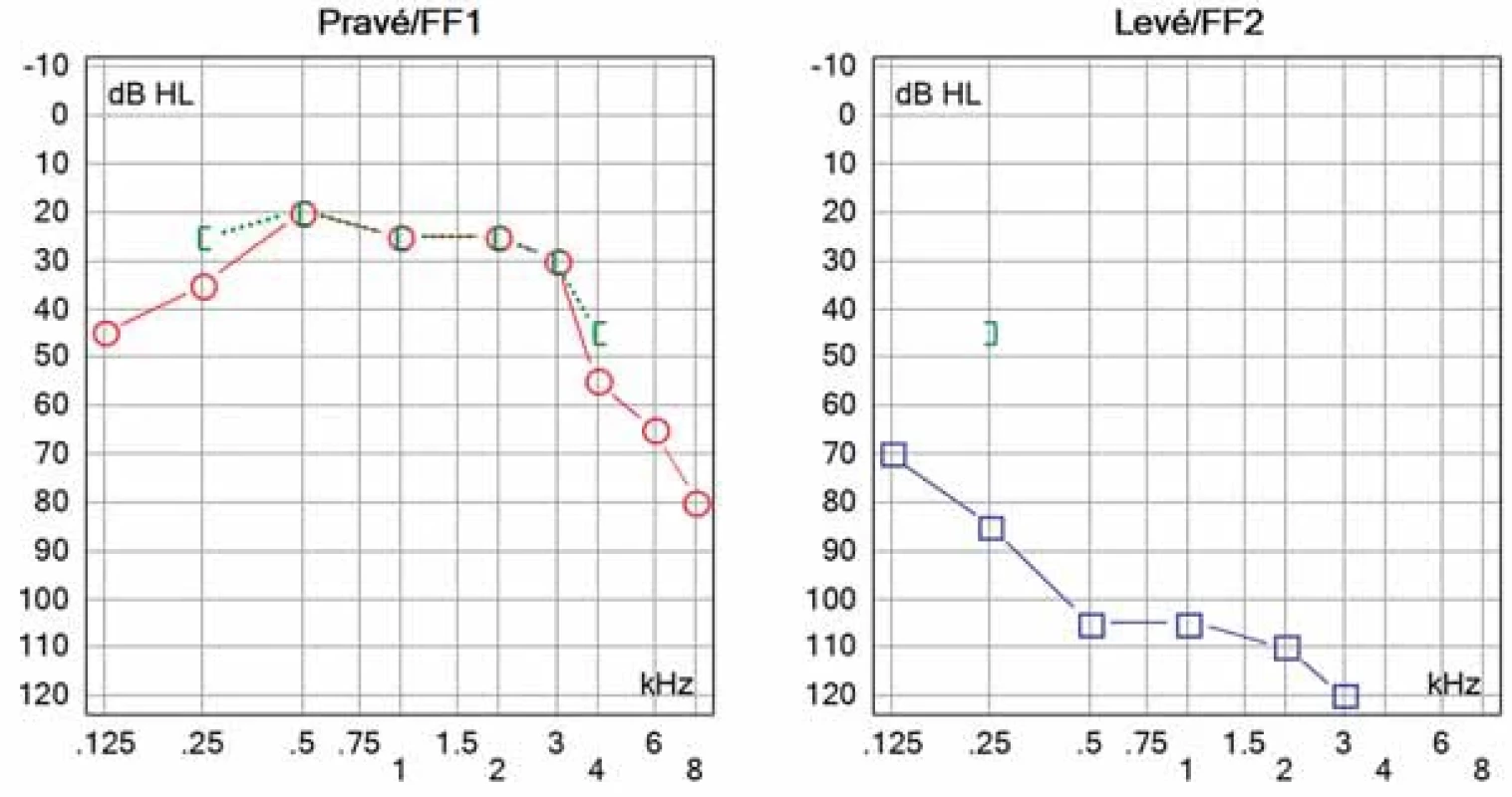 Prahový tónový audiogram měsíc po stanovení diagnózy s progresí ztráty sluchu hlavně vlevo.