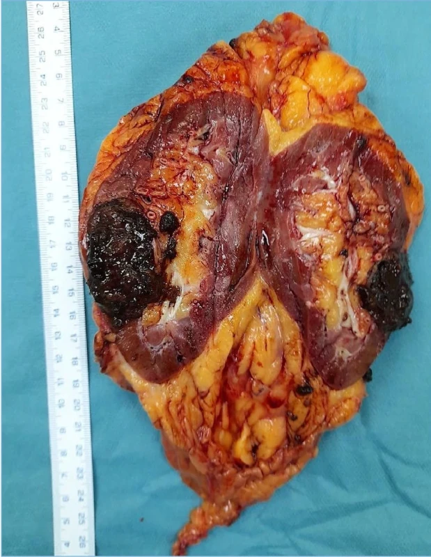 Preparát levé ledviny s intrarenálně uloženým hnědavým oválným tumorem. Na atypicky rozříznutém preparátu ledviny vidíme prokrvácený tumor místy s růstem směrem k renálnímu sinu. Fig. 2. Specimen of the left kidney with an intrarenally located brownish oval tumor. In the atypically sectioned kidney specimen, we observe a hemorrhagic tumor, in places with a clearly visible fibrous pseudocapsule, showing expansile growth toward the renal sinus.