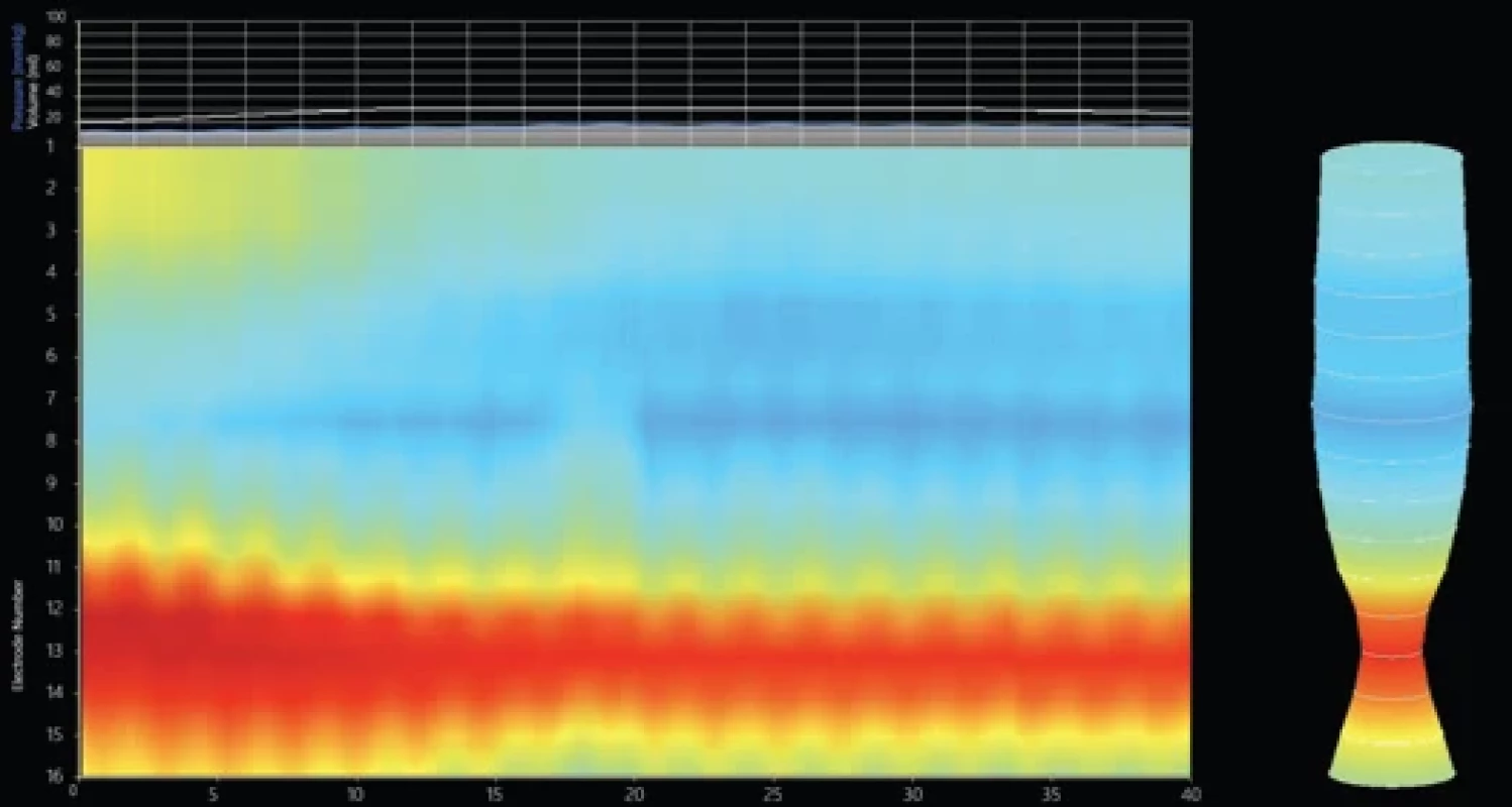 EndoFLIPTM topography showing typical image of achalasia type I. Obr. 􀍸. Nález z vyšetření Endofl ip™ s typickým obrazem achalázie typu I.
