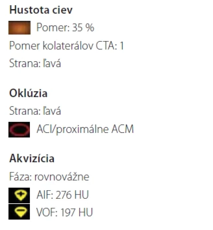Vyhodnotenie stavu kolaterálneho obehu v povodí uzavretej ACM vľavo pomocou softvéru umelej inteligencie e-CTA Brainomix® z CTA – podľa hodnotenia softvéru kolaterálny obeh zásobuje 35 % povodia uzavretej tepny, Tan kolaterálne skóre = 1.