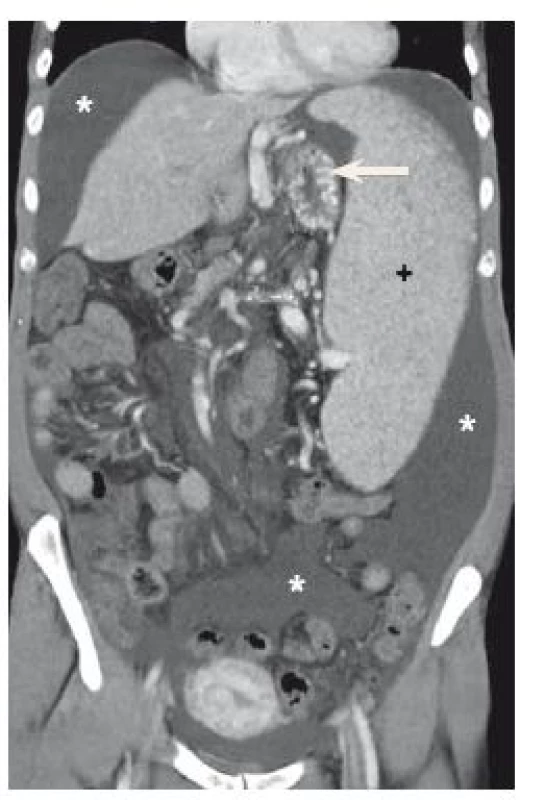 Ascites (*), splenomegalie (+), žaludeční varixy (šipka).
Fig. 1. Ascites (*), splenomegaly (+), gastric varices (arrow).