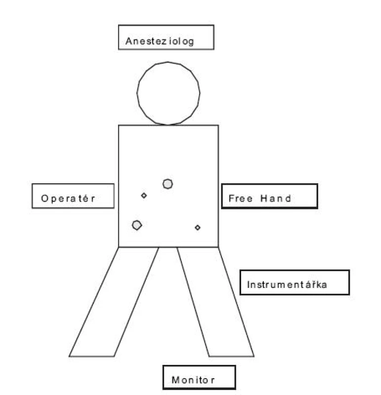 Schéma pozice pacienta, týmu a nástrojů u resekce kolon sigmoideum
Pic. 1. The schema of position of patients, the operating team, and the instruments in resection of sigmoid colon