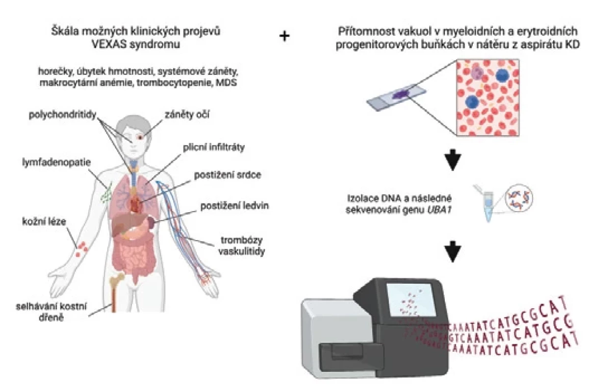 Souhrn možných klinických projevů vyskytujících se u pacientů s VEXAS syndromem vedoucích k indikaci vyšetření genu UBA1. Vytvořeno autory pomocí BioRender.com.