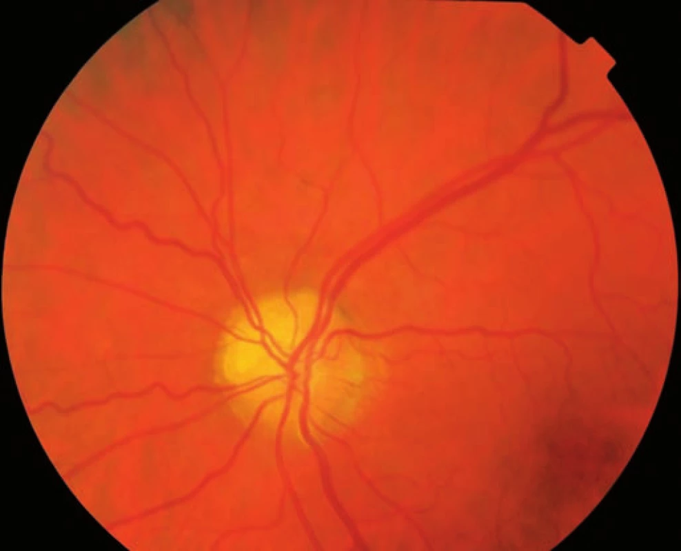 Fundus fotografia ľavého oka (pacient č. 1).
Viditeľné povrchovo uložené drúzy hlavne v hornej nazálnej časti, tortuozita nazálnych venóznych vetiev.