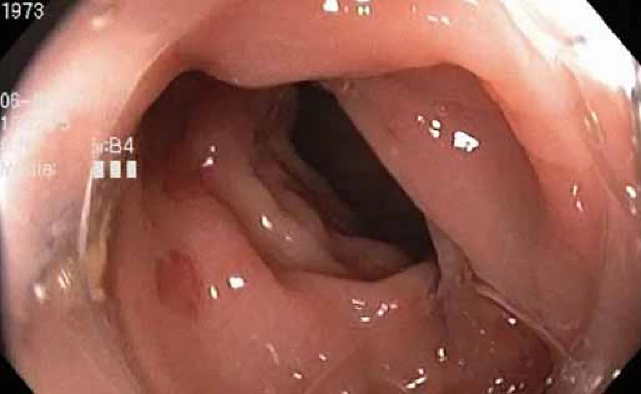 Normální nález po 5měsíční léčbě vedolizumabem, tlusté střevo.
Fig. 5. Normal finding after 5 months of treatment with vedolizumab, large intestine.