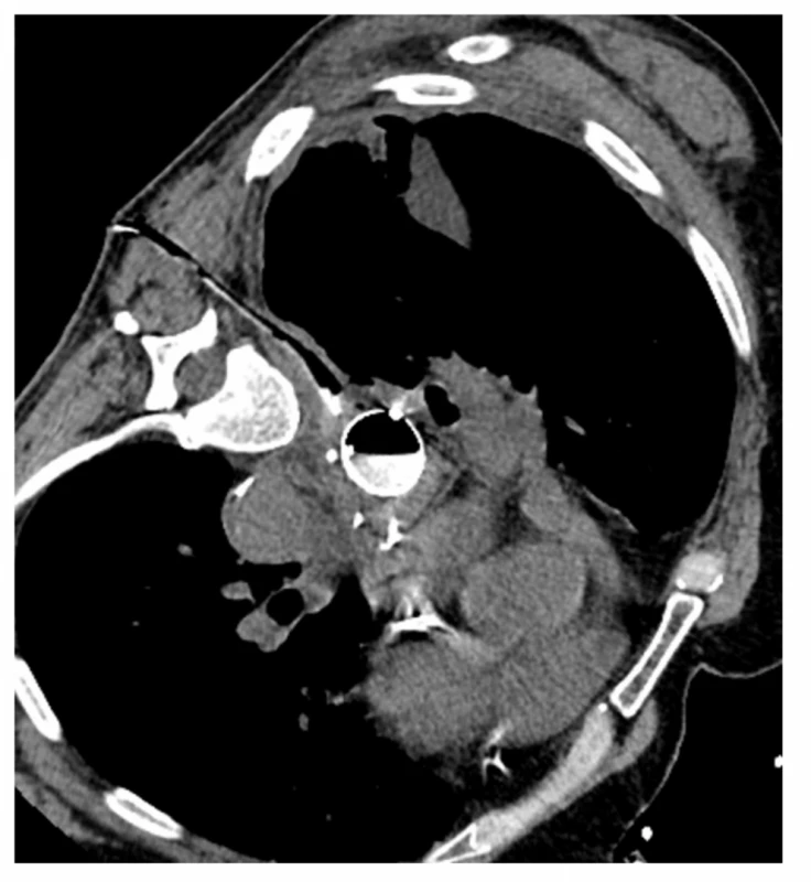 CT navigovaná drenáž mediastinálního abscesu,
v jícnu stent<br>
Fig. 6: CT guided drainage of mediastinal abscess, stent
in the esophagus