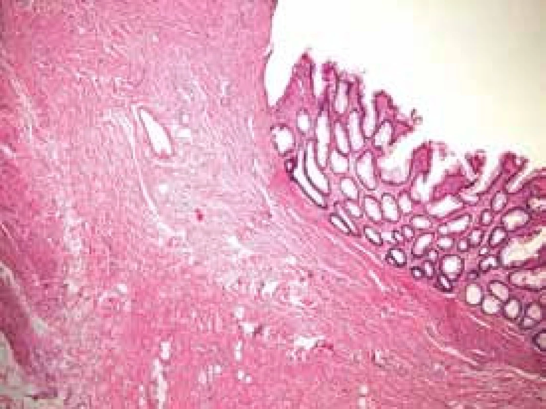 Histologické vyšetření po léčbě prokazuje sliznici a submukózu s chronickými fibrózo produktivními změnami. Floridní zánětlivé změny ani slizniční defekt již nejsou přítomny.
Fig. 3. Histology specimen after the therapy proved a chronic fibroproduction in rectal mucosa and submucosal tissue. The acute inflammatory changes are not present.