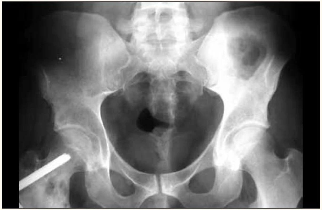 Osteolytické ložisko femuru vpravo u osteosyntetického materiálu na RTG snímku pánve.
