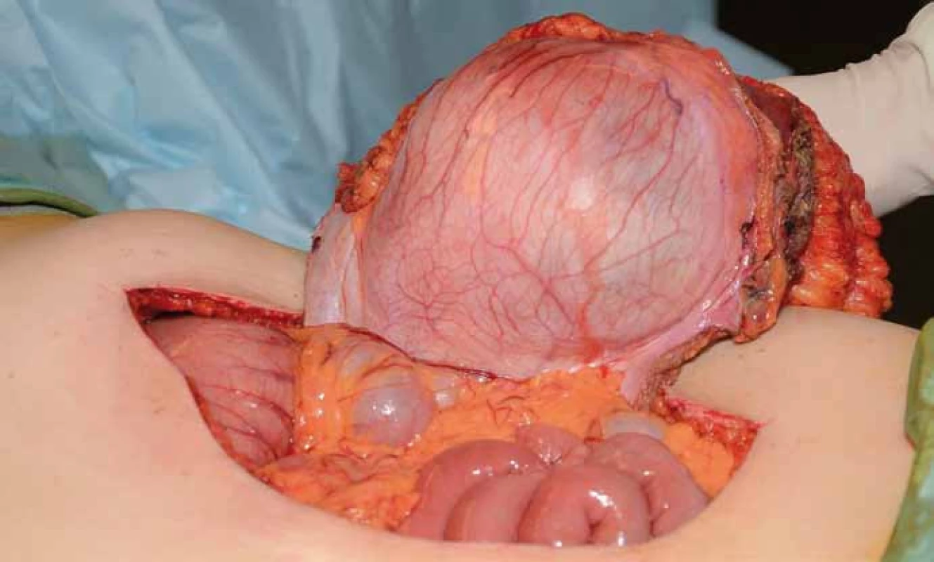 Resekovaný tumor s břišní stěnou.