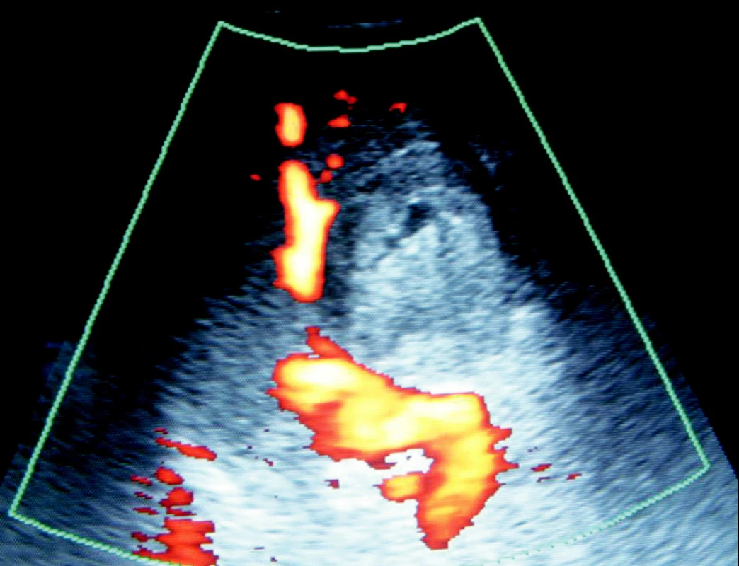 Ultrasonografický obraz trombózovaného pseudo-aneuryzmatu tepny v oblasti kaudy pankreatu
Fig. 4. Ultrasound view of the thrombotized arterial pseudoaneurysm within the pancreatic cauda