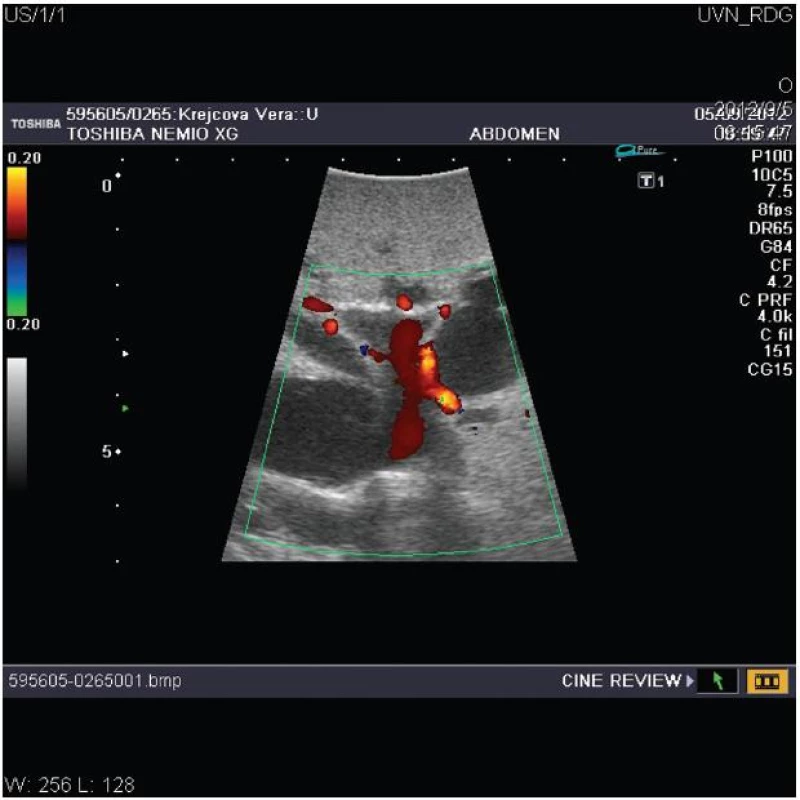 Peroperační ultrasonografie jater s dopplerovským vyšetřením znázorňující dilataci nitrojaterních cest u hilového nádoru typu Bismuth III s průchodnou levou větví a hlavním kmenem portální žíly
Fig. 3: Intraoperative ultrasonography of the liver with doppler investigation shows dilatated biliary intrahepatic ducts due to hilar cholangiocarcinoma type Bismuth III with patent left portal branch and main portal trunk