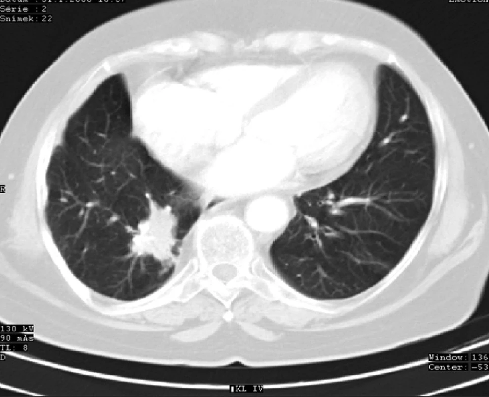 CT plic s ložiskem recidivy karcinomu v dolním laloku pravé plíce (4 roky po operaci)
Fig. 5: Lung CT showing lung cancer recurrence with a focus in the lower lobe of the right lung (4 years after surgery)