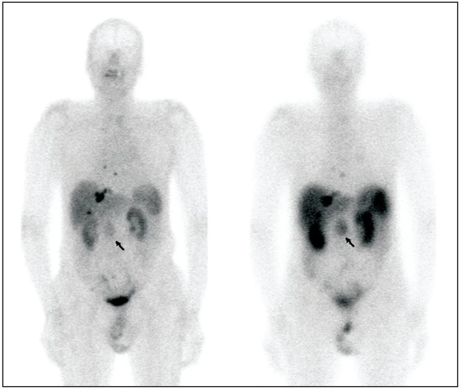 Pacient s karcinoidem tenkého střeva, primární tumor označen šipkou. Pro srovnání zobrazeno celotělové vyšetření <sup>99m</sup>Tc-Tektrotyd (vlevo) a <sup>111</sup>In-Octreoscan (vpravo). Anatomická lokalizace ložisek zobrazena na obrázku 2.