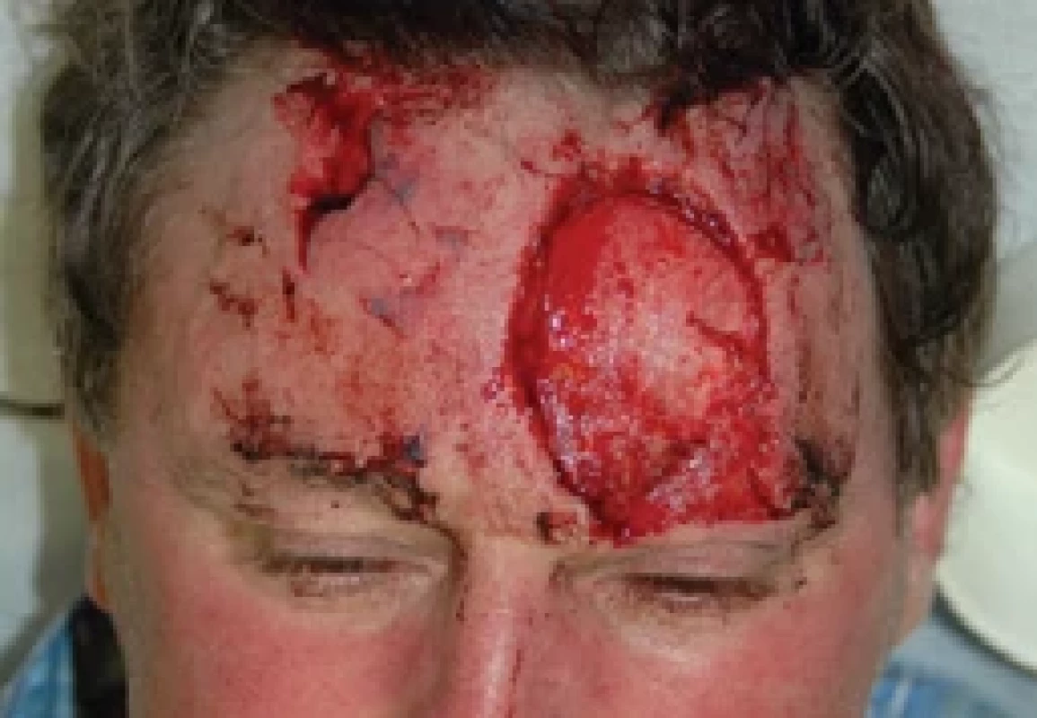 Forehead avulsion defect. Source: archive of authors.