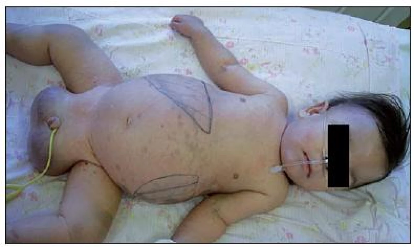 Výrazná hepatosplenomegália u pacienta s GM1 gangliozidózou.
Fig. 1. The marked hepatosplenomegaly in a patient with GM1 gangliosidosis.