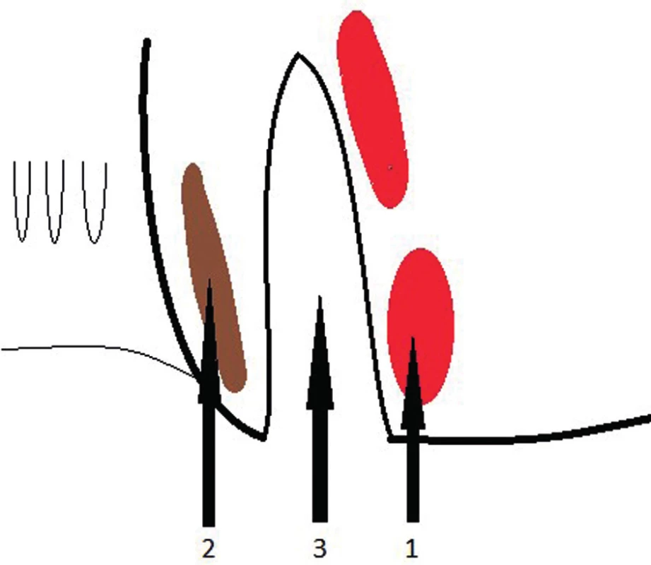 Přístup do intersfinkterického prostoru
1 – m. sphincter ani externus, 2 – m. sphincter ani internus, 3 – interfinkterický prostor
Fig. 5: Access to the intersphincteric area
1 – m. sphincter ani externus, 2 – m. sphincter ani internus, 3 – intersphincteric area