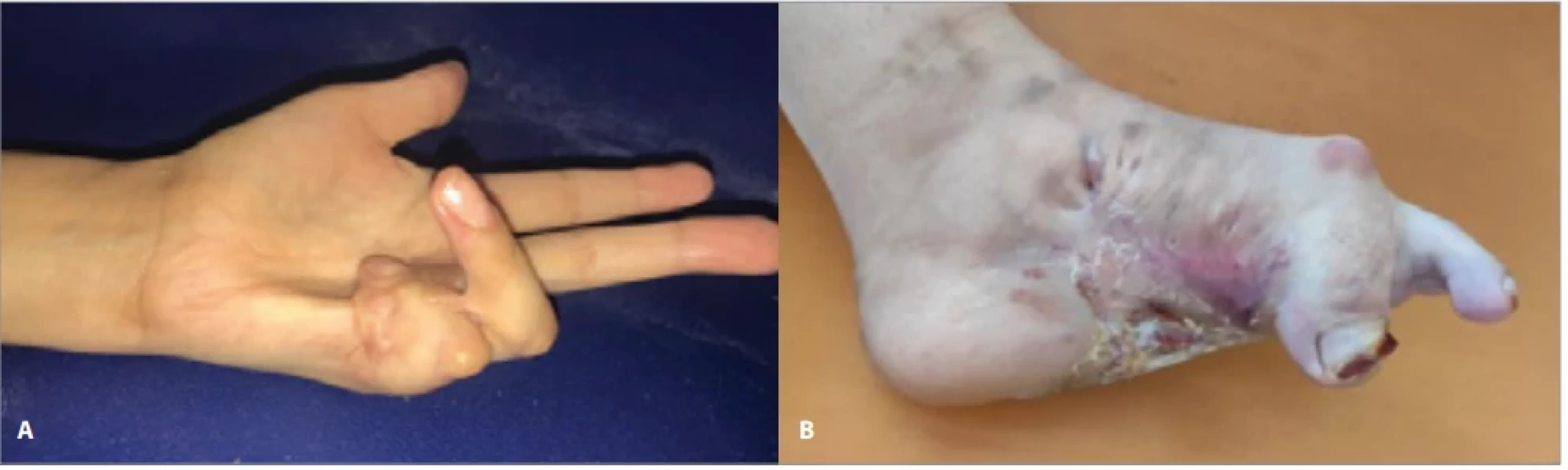 Keloid on the palmar surface of the left hand causing digital retraction (A); plantar keloid causing fl exion of the hallux (B).
