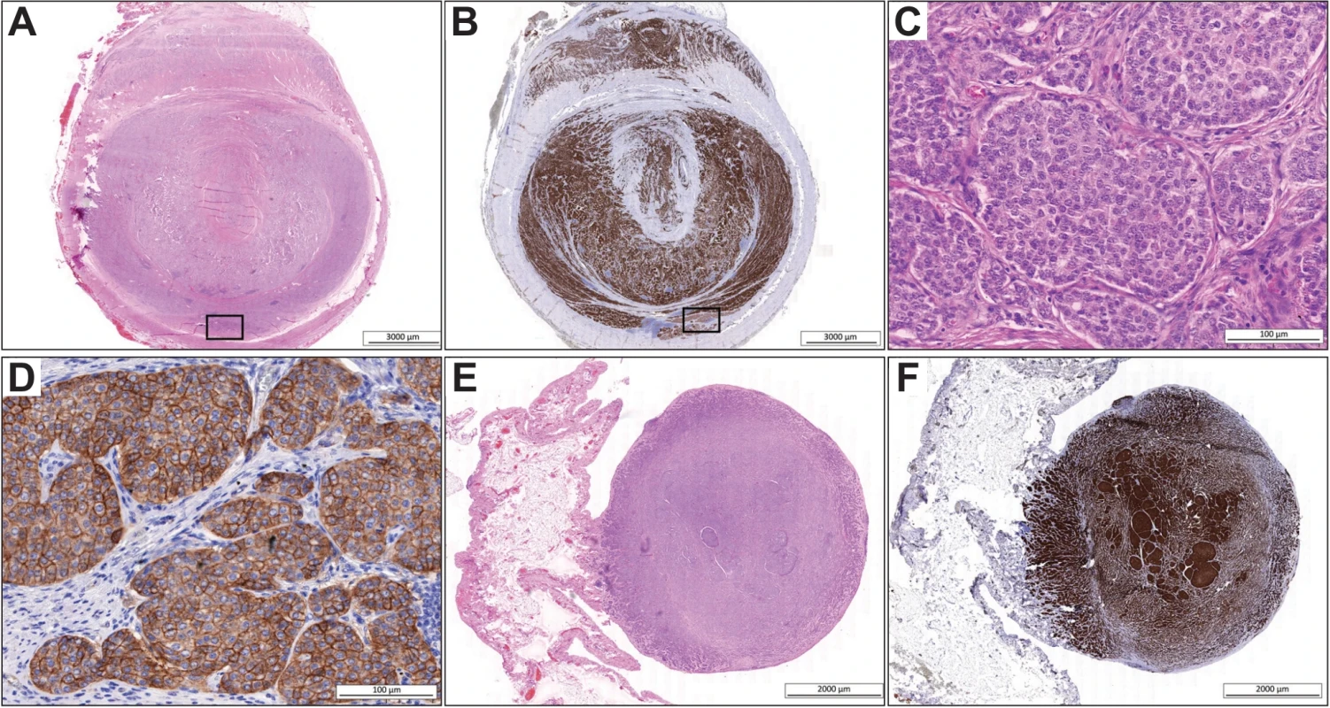 Primární NET G1 apendixu (A–D) a jeho peritoneální metastáza (E–F). V A i B NET vyplňuje lumen apendixu a infiltruje stěnu až na serózu. C a D detailní uspořádání tumoru z místa odpovídající čtverci v obrázku A i B, výrazná je membránová exprese SSTR-2. Silná exprese SSTR-2 je patrná i v peritoneální metastáze (F). Obrázky A, C, E byly obarveny v H&E, obrázky B, D, F s imunohistochemickou reakcí proti SSTR-2. Originální zvětšení obrázku 10x (A, B, E, F) a 400x (C a D).