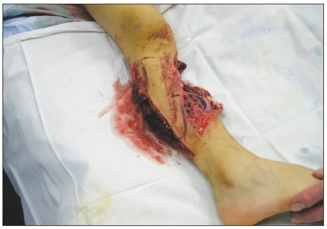 Soft tissue defects of the calf