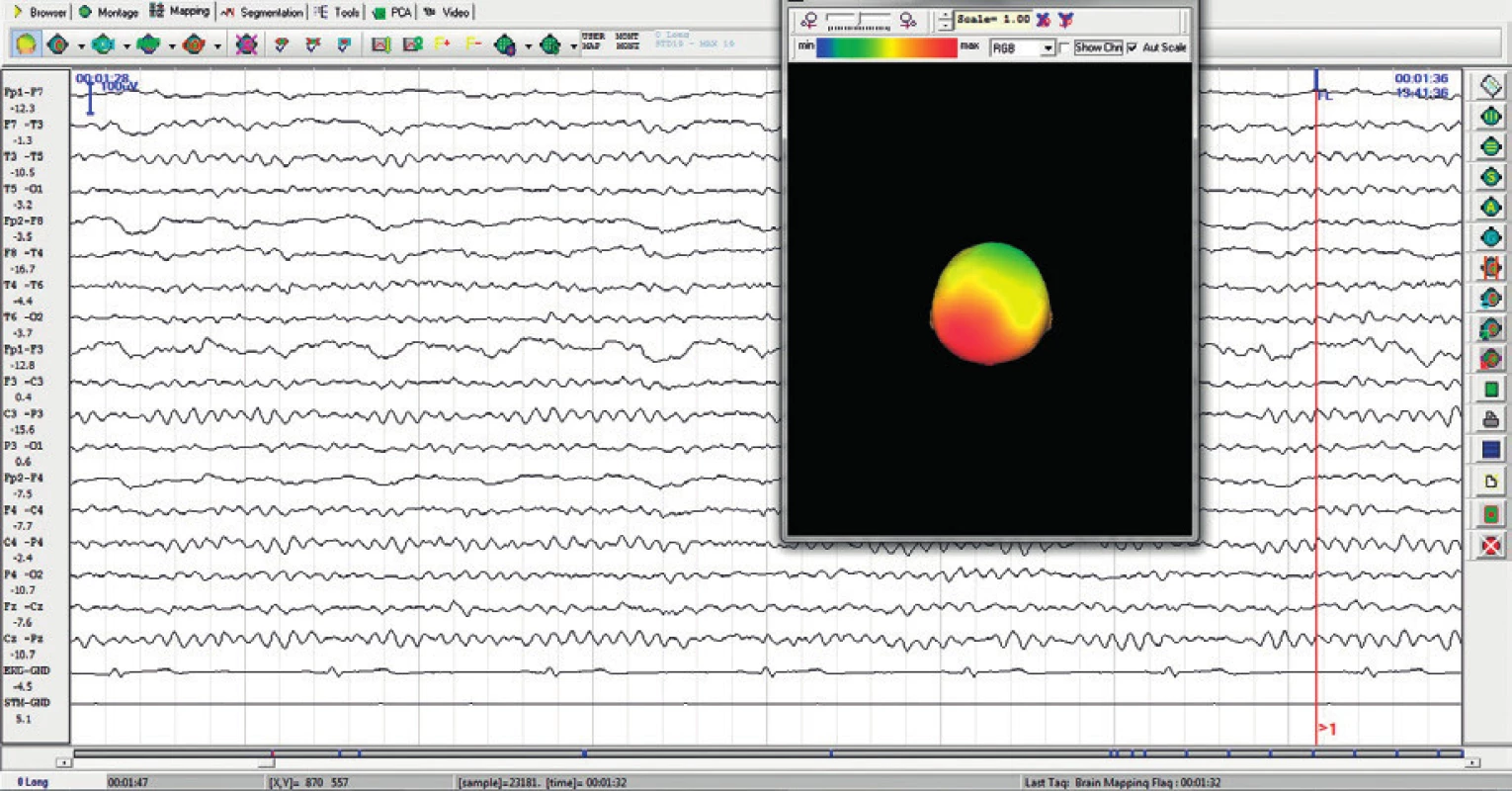 Amplitudový brain mapping. Červený kurzor označuje místo výpočtu aktuální amplitudy.