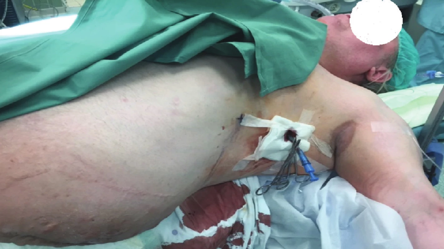 Hrudník se zavedeným drénem
Fig. 2: Thorax with inserted drain