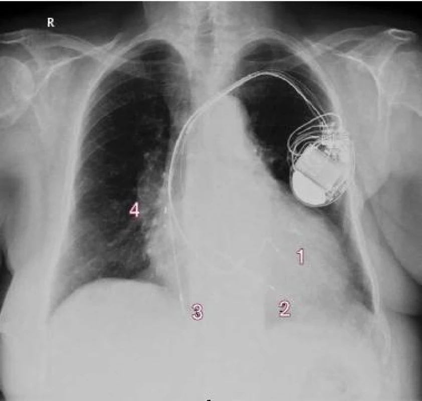 Kontrola za 14 dnů od implantace – předozadní snímek.