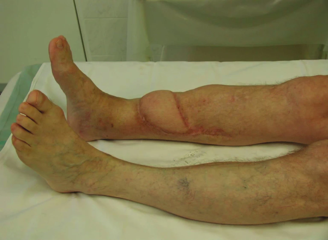 Pacient s otevřenou zlomeninou pilonu tibie 43C3 O IIIB - stav po konverzi na dlahovou osteosyntézu, řešení defektu měkkých tkání s použitím volného svalového laloku