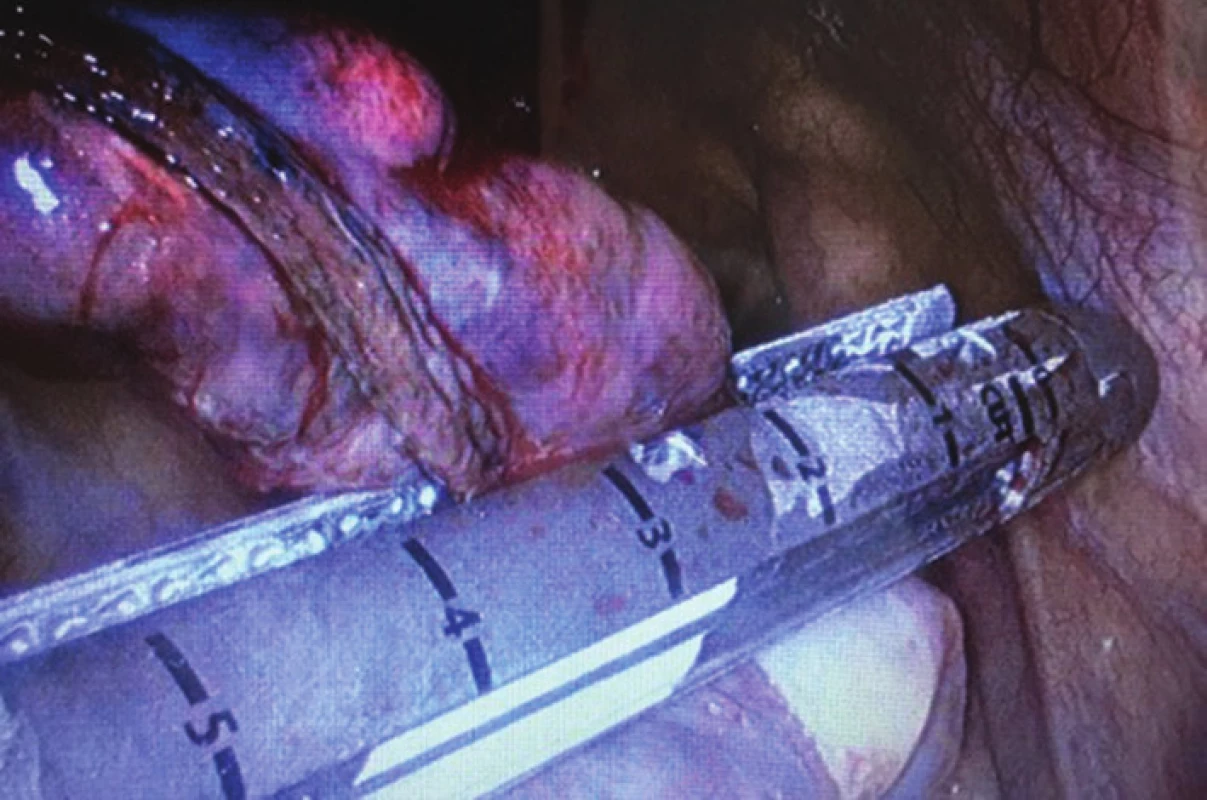 Uniportal resekce apexu pravé plíce (pohled pomocí reverzní 30 stupňové optiky)
Fig. 2: Uniportal resection of the right lung apex (30-degree reversed optic view)