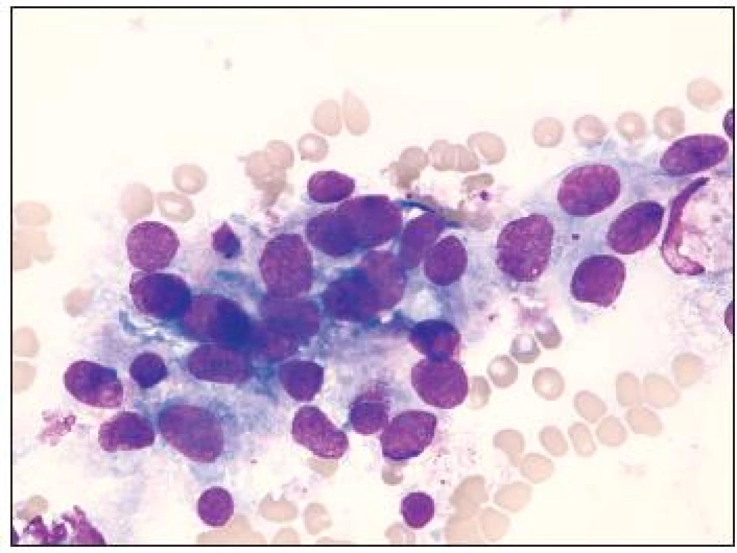 Aspirát kostní dřeně, panoptické barvení, zvětšení 1000x: Shluk maligních nehematopoetických buněk s nestejně velkými kulatými či oválnými jádry, většinou s jemným chromatinem a s více jadérky, nehomogenně bazofilní, místy jemně vakuolizovaná neohraničená cytoplazma.