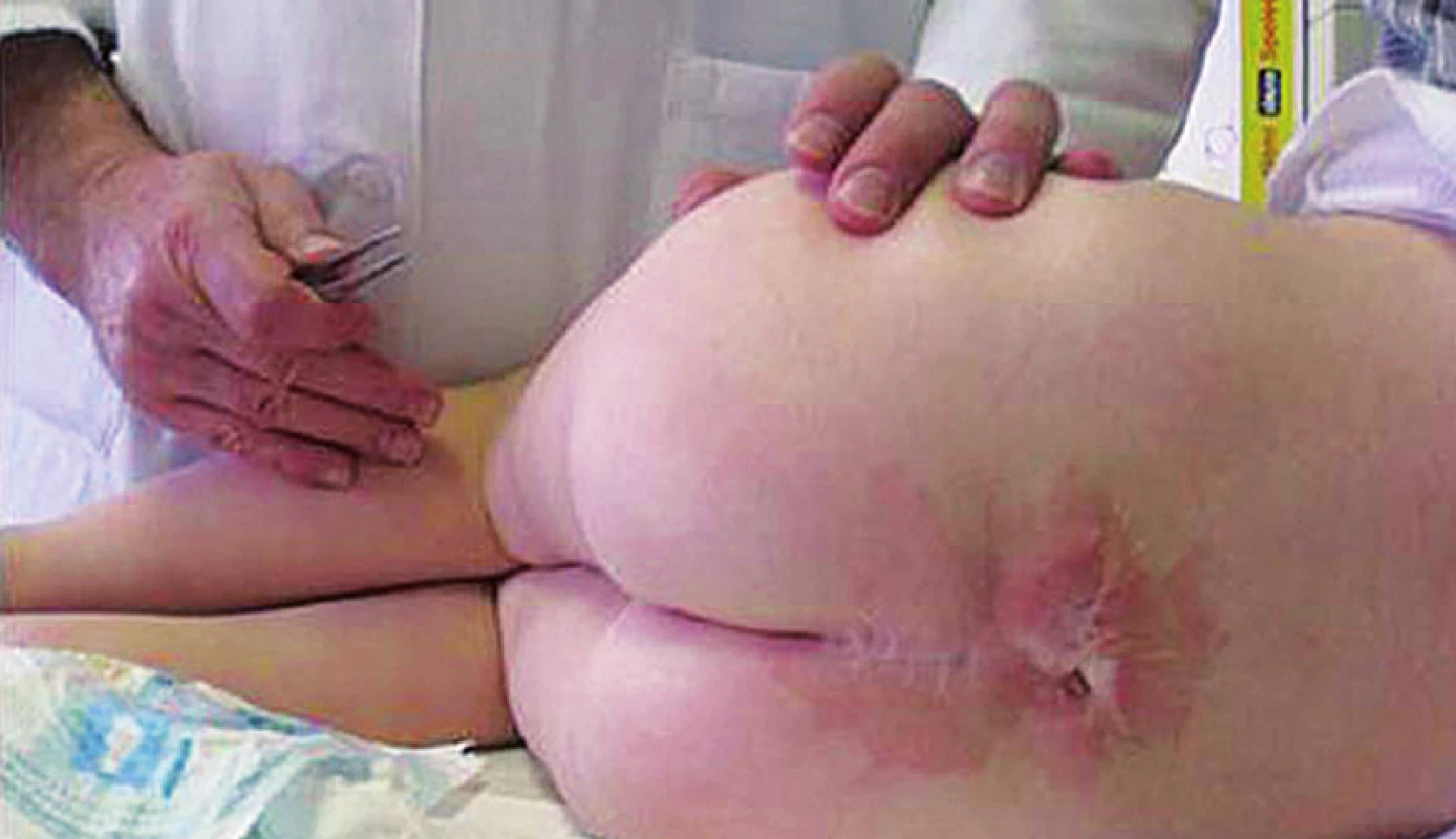 Jizva po operaci meningomyelokély u čtyřleté pacientky – riziko vzniku fixované míchy.
Fig. 3. Cicatrice after operation on meningomyelocele in a four-year girl – the risk of origin of fixed spinal cord.