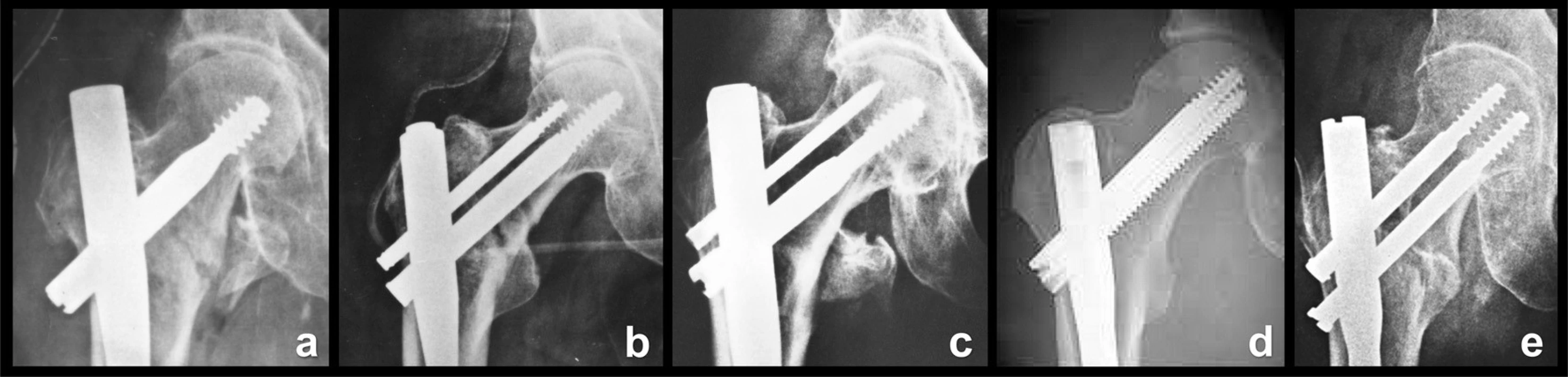 Konstrukce skluzných šroubů a čepelí: a – Gamma hřeb Howmedica; b – PFN Synthes; c – Targon BBraun; d – Intertan Smith and Nephew; e – PFN Medin.
Fig. 5: Design of lag screws and blades: a – Gamma nail Howmedica; b – PFN Synthes; c – Targon B-Braun; d – Intertan Smith and Nephew; e – PFN Medin.