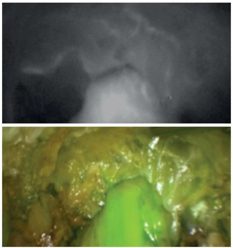 Obraz NIR fluorescentní angiografie a superponovaný obraz v normálním světle
Fig. 2: NIR perfusion assessment and superposition of NIR and normal light