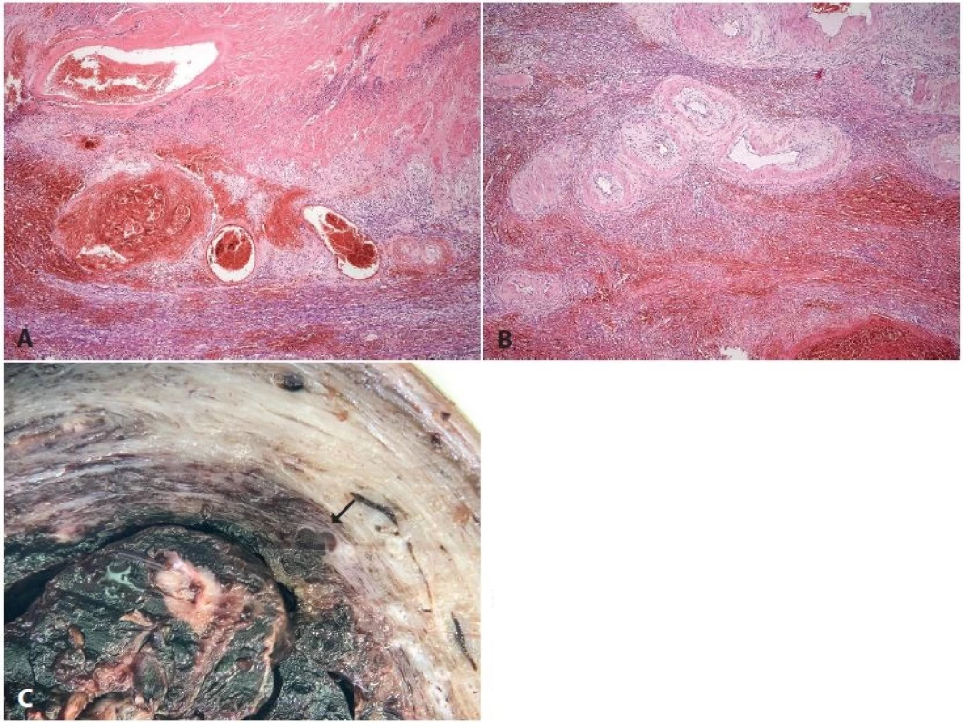 <b>Subinvoluce cév placentárního lůžka</b>. Hysterektomie 2 týdny po porodu pro puerperální sepsi. Histologicky flegmonózní zánět dělohy s přechodem do parametrií, subinvoluce cév placentárního lůžka (makrofotka z jiného případu s velmi podobnou anamnézou). <b>A, B</b>: různý stupeň involuce spirálních arterií (HE, zvětš. 40x). <b>C</b>: makrofoto patologicky neuzavřené spirální arterie (šipka).