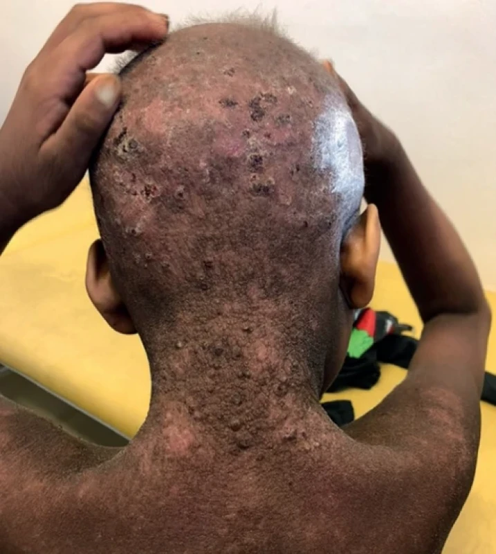 Alopecie u pacienta s KID syndromem. Zdroj: archiv autorky MUDr. Petry Gkalpakioti