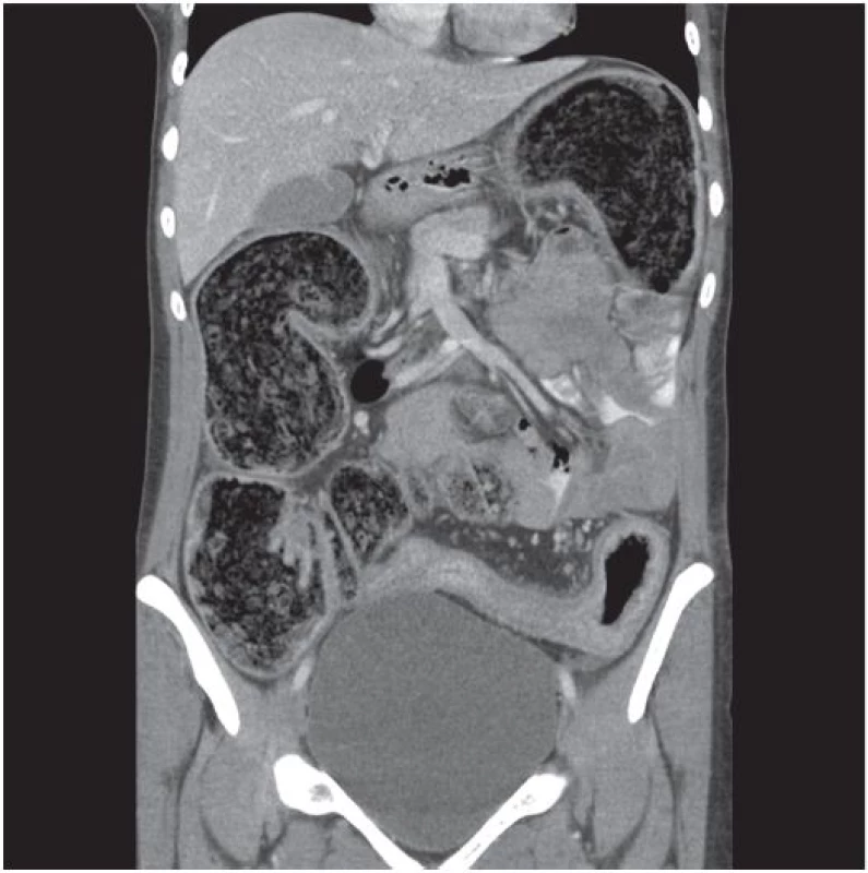 CT: Extrémní rozšíření tračníku, stenóza sigmatu
Fig. 1 CT: Extremely dilated large bowel, sigmoid stenosis