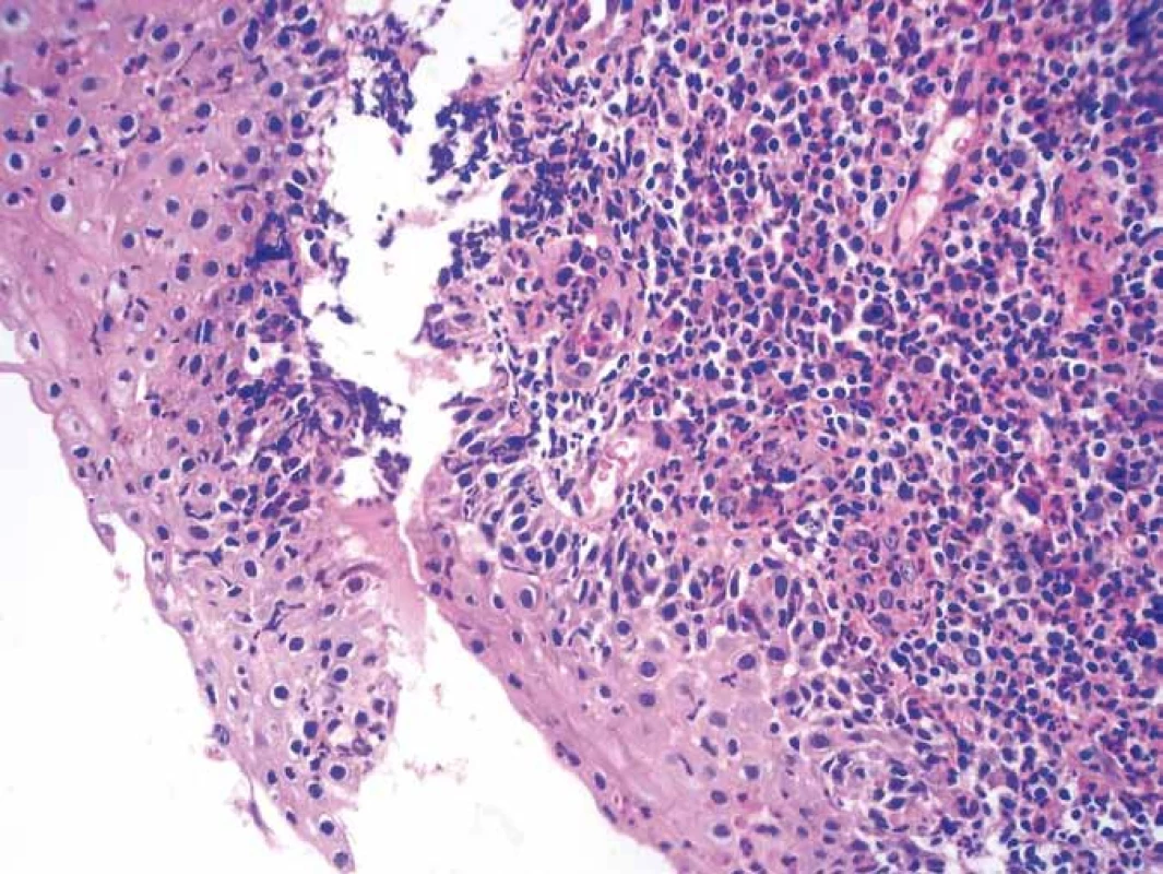 Biopsie – ezofagitida, barvení HE 400×.
Fig. 2. Biopsy – esophagitis, HE staining 400×.